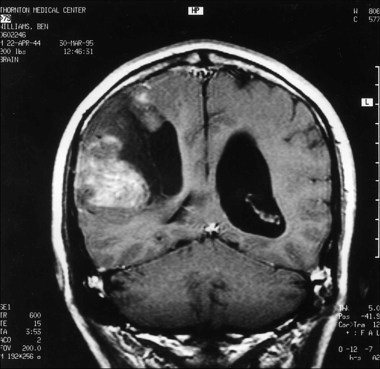 1 pav. MRT pjūvis per smegenų vidurį tarp priekio ir galo, rodantis glioblastomos naviką