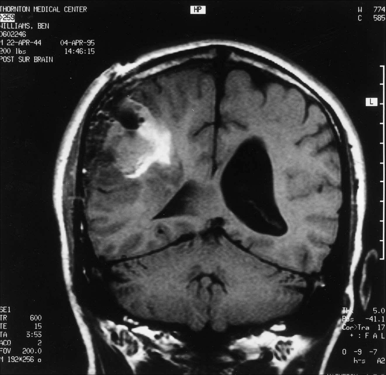 3 pav. Pooperacinis MRT pjūvis per smegenų vidurį tarp priekio ir galo