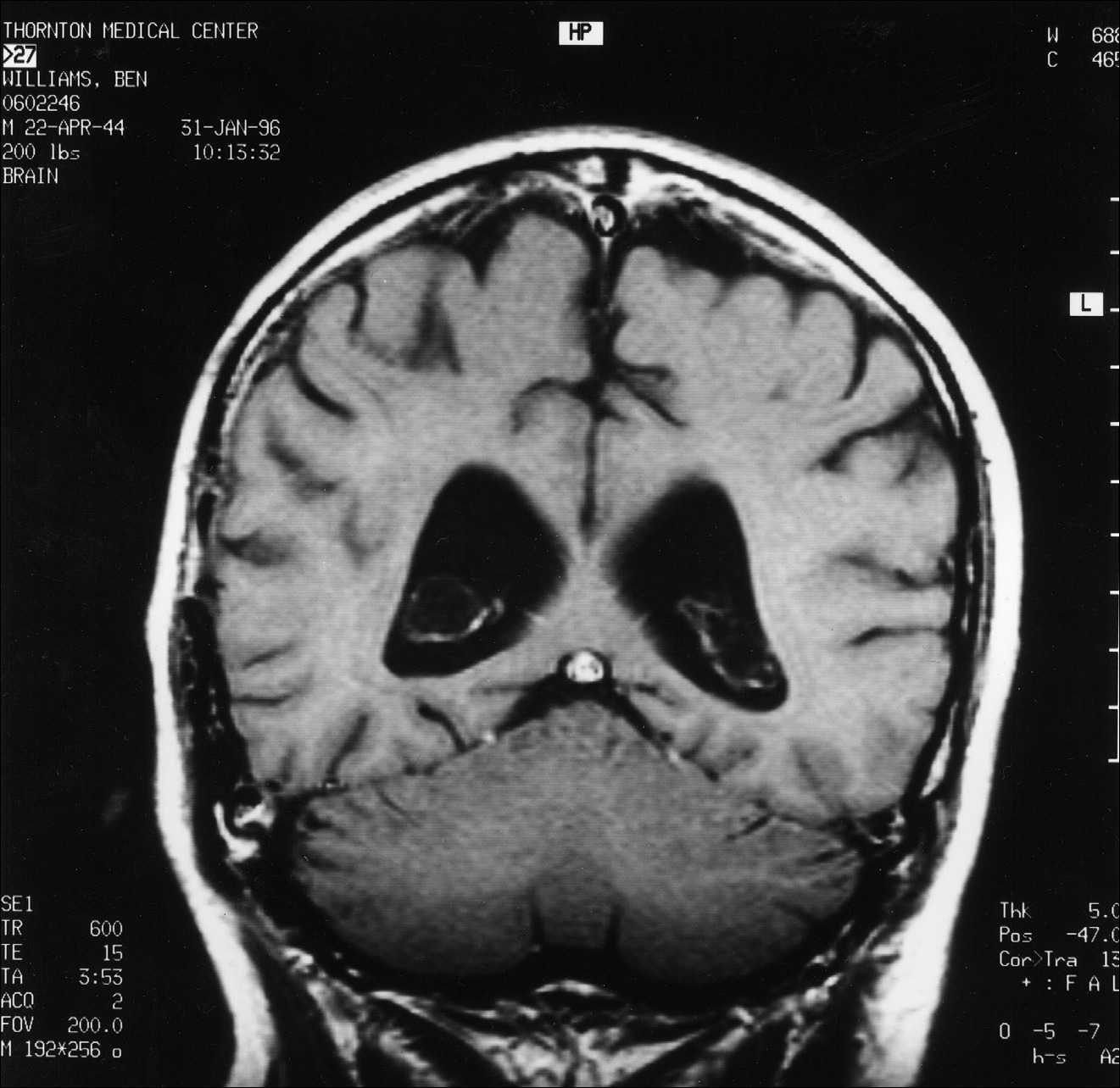 5 pav. MRT pjūvis, atitinkantis 1 ir 3 paveikslėlių pjūvius