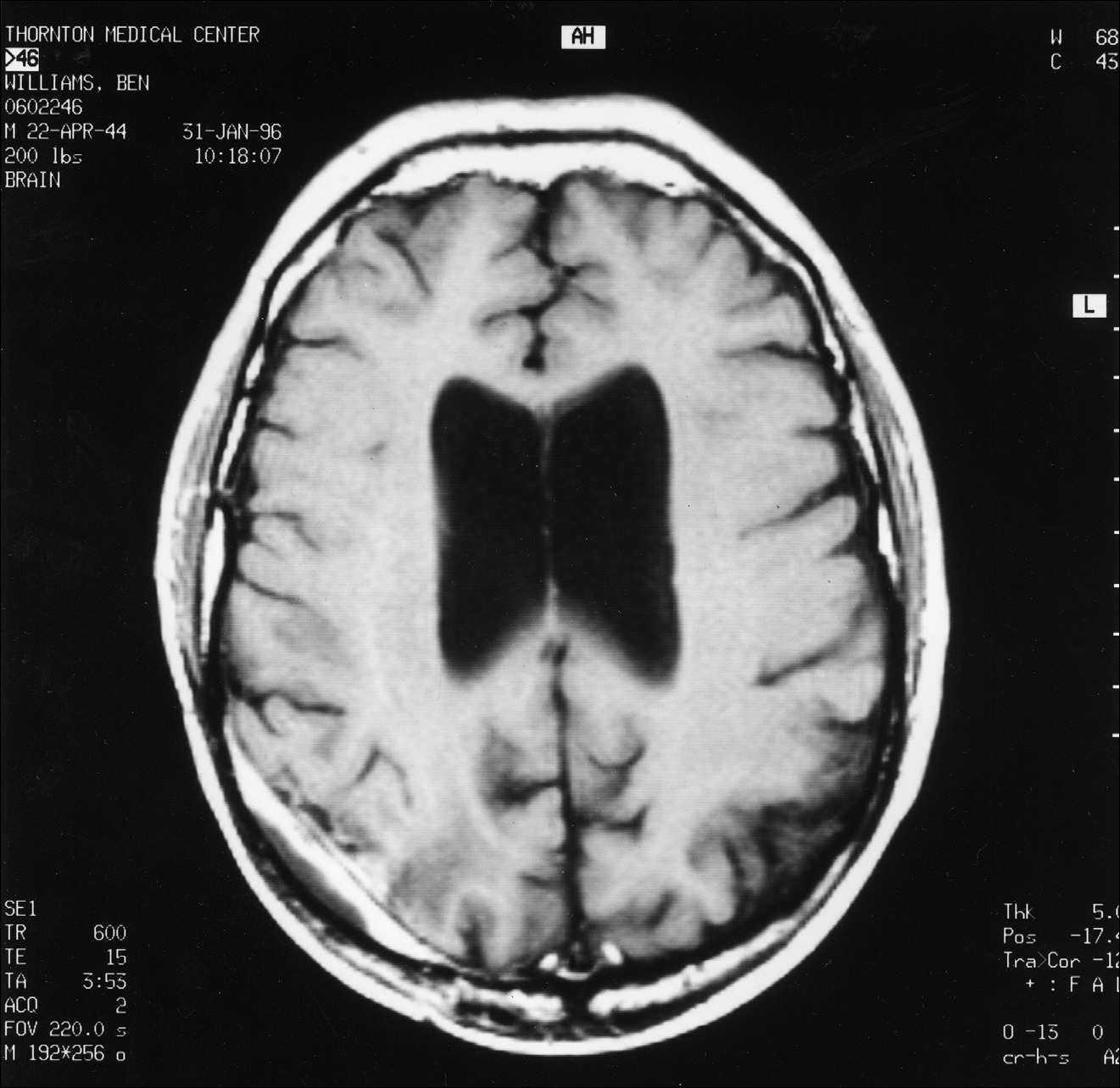 6 pav. MRT pjūvis, atitinkantis 2 ir 4 paveikslėlių pjūvius — matomas nedidelis paryškinimas